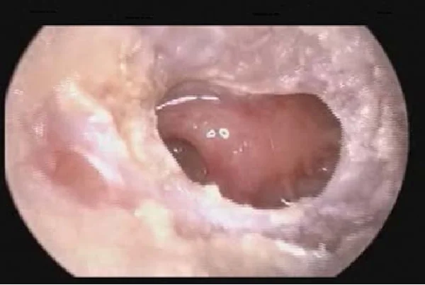 Oto Endoscopy