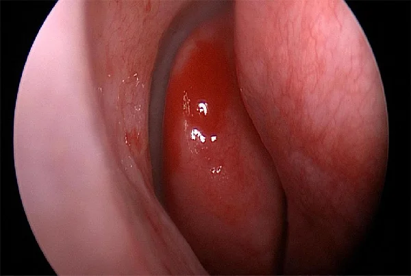 Nasal Endoscopy