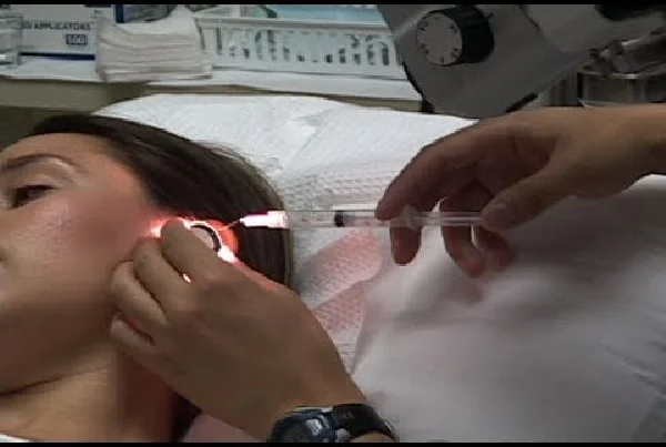 Intratympanic injection
