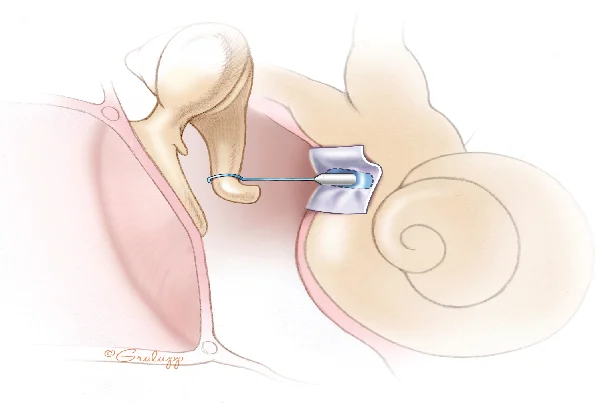 Stapedotomy