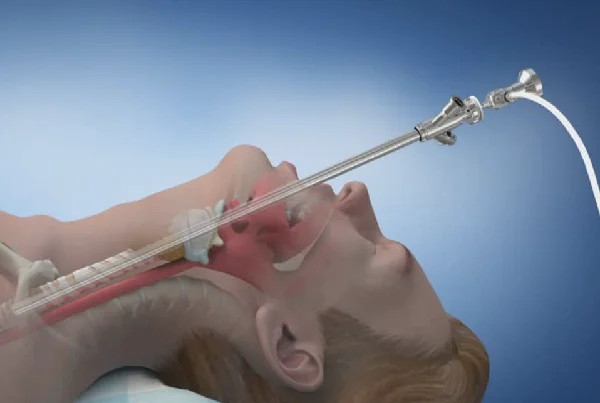 Rigid bronchoscopy