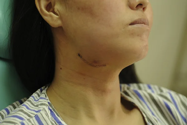 Sub mandibular gland resection