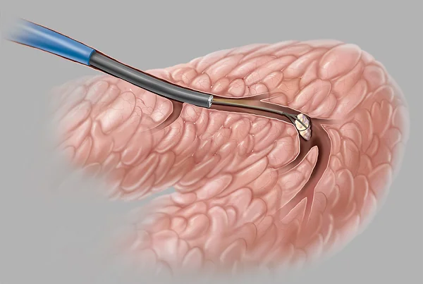 Sialendoscopy